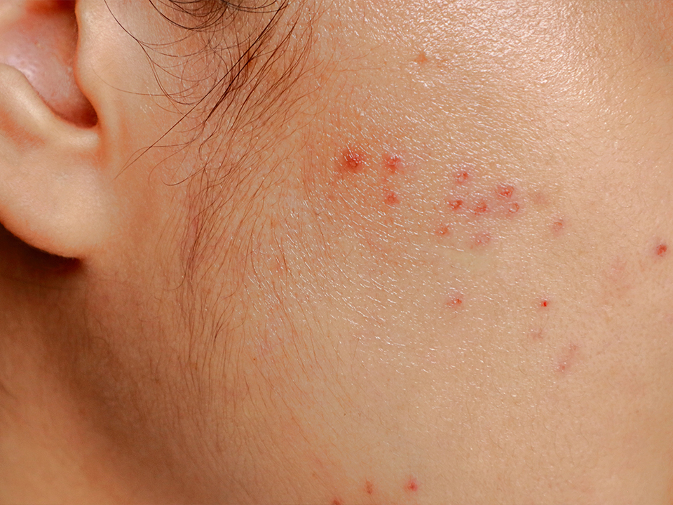 Hudproblem efter användning av hormonellt preventivmedel